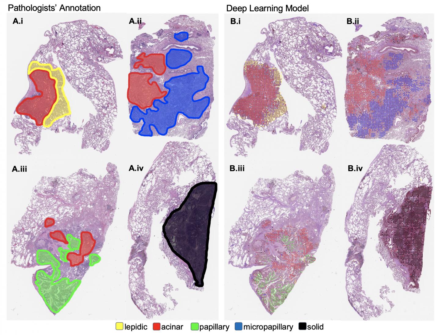 machine learning lung cancer